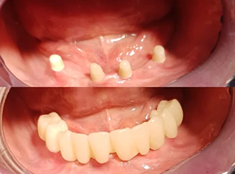 Имплантаты Cerera - протезирование беззубой челюсти